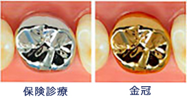 さし歯、被せ物について